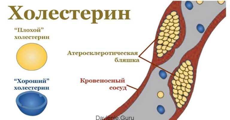 Сосуды забитые холестерином фото